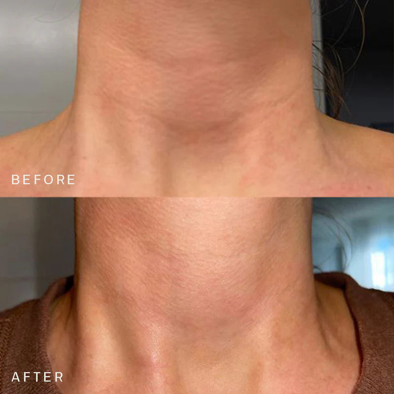 ANTI WRINKLE PATCHES NECK