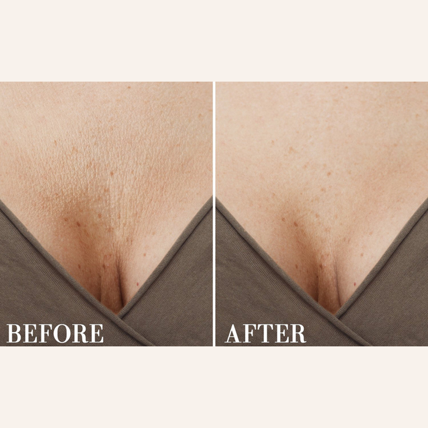 ANTI WRINKLE PATCHES CHEST