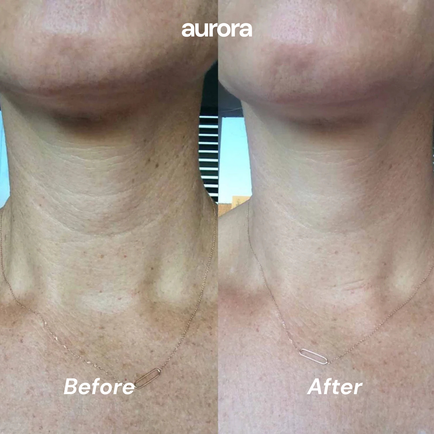 ANTI WRINKLE PATCHES NECK